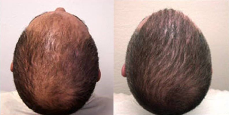 Male Hair Before and After NeoGraft® Automated Hair Transplantation System
