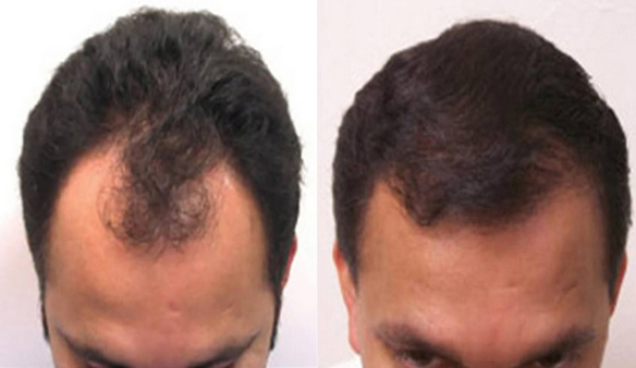 Hairline Before and After NeoGraft® Automated Hair Transplantation System