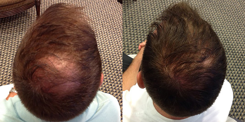 Male Crown Before and After Hair Restoration using NeoGraft Automated Hair Transplantation System.