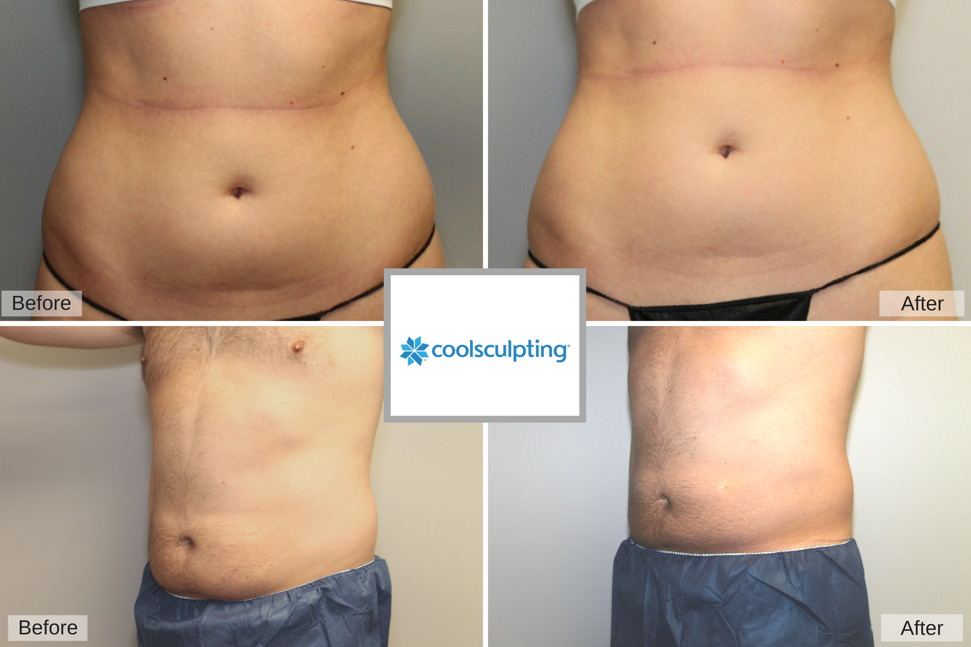 Freeze Fat Away with CoolSculpting® at Capizzi MD