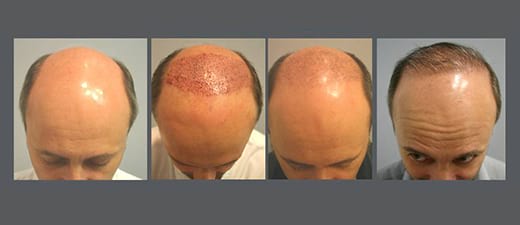 Hair Growth after NeoGraft Procedure.