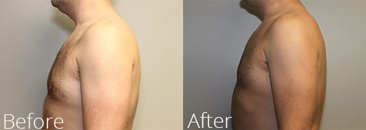 Before and After Gynecomastia Image