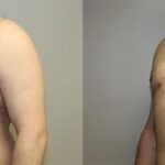 https://capizzimd.com/wp-content/uploads/2018/07/Gynecomastia-2-Front-Facing-Image-OP-GT.jpg