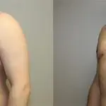 https://capizzimd.com/wp-content/uploads/2018/07/Gynecomastia-2-Front-Facing-Image-OP-GT.jpg