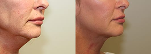Patient is in her 50s and received 2 treatments of Kybella.