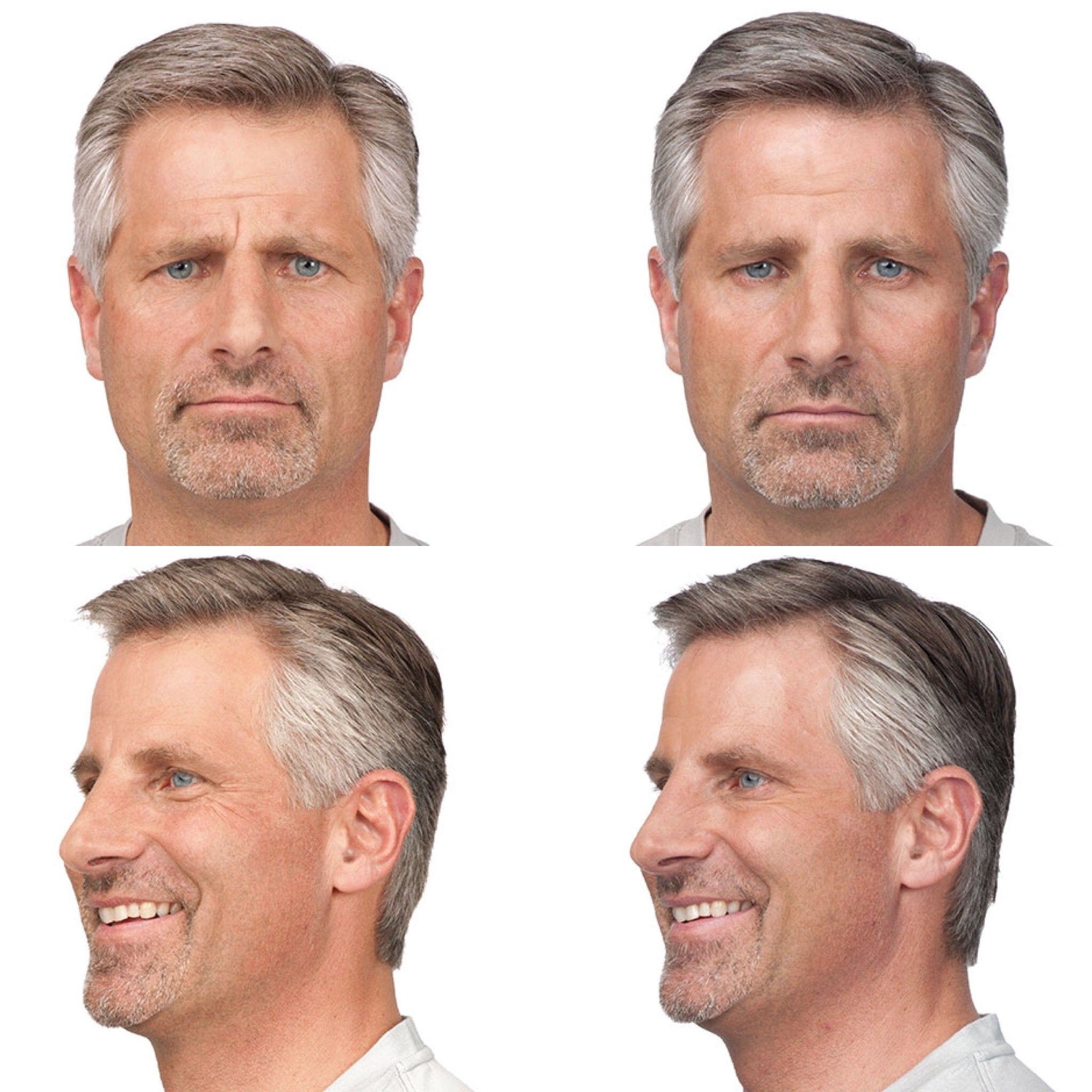 Mens Botox Before And After
