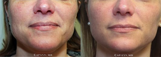 Image of Patient 3 months post-procedure Less wrinkles due to stimulation of collagen, reduction in sunspots and acne scars, smoother and even skin tone Front View