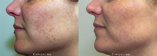 Image of Patient 3 months post-procedure. Less wrinkles due to stimulation of collagen, reduction in sunspots and acne scars, smoother and even skin tone. Left Side View.