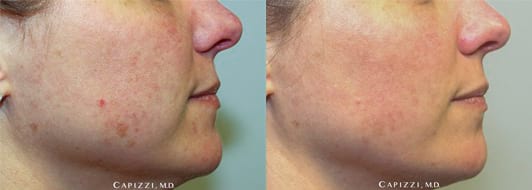 Image of Patient 3 months post-procedure. Less wrinkles due to stimulation of collagen, reduction in sunspots and acne scars, smoother and even skin tone. Right Side View.
