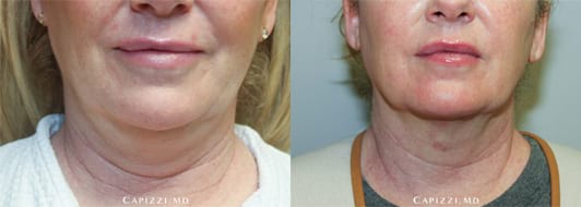 Results from 1 Kybella treatment, 3 months post-injection.