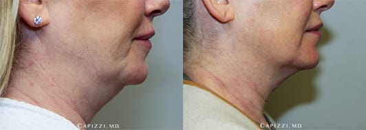 Results from 1 Kybella treatment, 3 months post-injection. Side View.