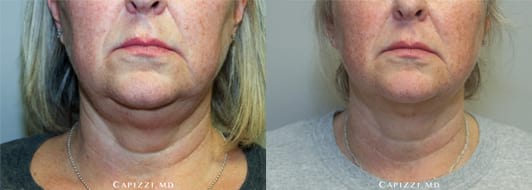 1 treatment of KYBELLA® to neck for fat elimination. Patient is 3 months out (in after photo). Front View.,
