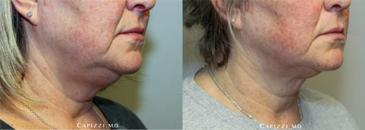 1 treatment of KYBELLA® to neck for fat elimination. Patient is 3 months out (in after photo). Oblique View.
