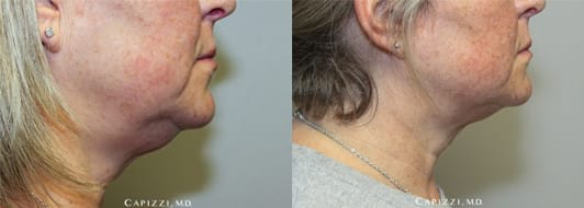 1 treatment of KYBELLA® to neck for fat elimination. Patient is 3 months out (in after photo). Side View