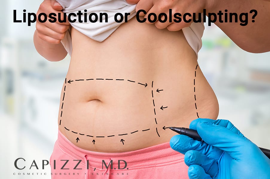 Liposuction Or CoolSculpting?