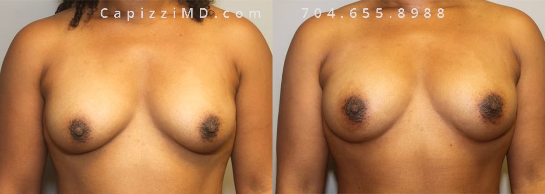 ES Front Fat Grafting 170 cc fat injected into each breast 3 mos post-op Large Image