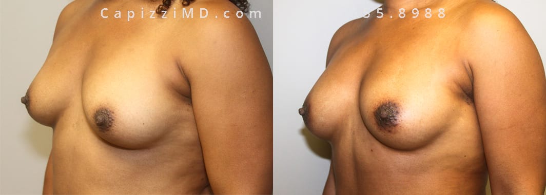ES Oblique Fat Grafting 170 cc fat injected into each breast 3 mos post-op Large