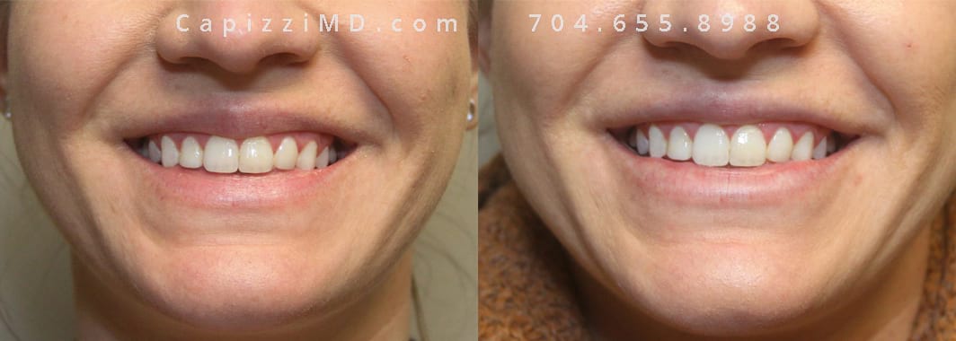 Vollure Lips 1 Smile Large Image Before and After Pics