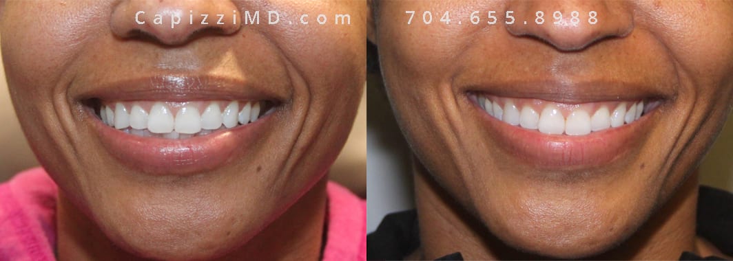 Vollure Smile Lines 2 Large Image Before and After