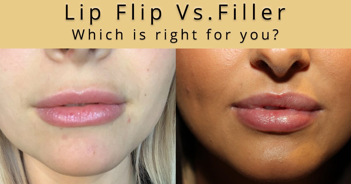 Lip flip or lip filler — which is right for you?