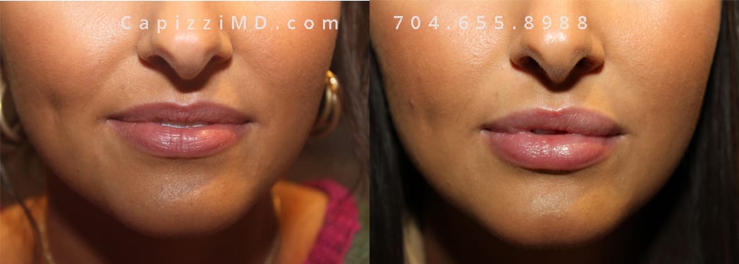 Large Vollure filler treatments before and after of women's lips, mouth closed.