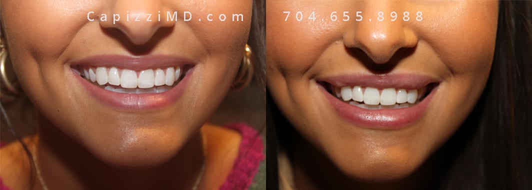 Large Vollure filler treatments before and after of women's lips, smiling.
