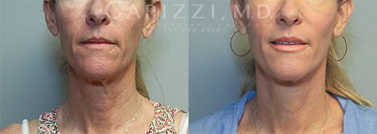 PP Mini Neck Lift and MicroLaser Peel Front view of 45-year-old woman, 3 months post-op
