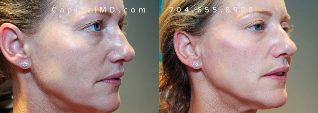1 syringe of Voluma to this patient’s cheekbones. Post pics are taken immediately after treatment. Notice how lifting the cheeks helped reduce under eye circles.