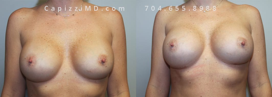 Desired more volume and cleavage. Sientra Textured Round High Projection 505cc. Post-op 3 months. Front view.