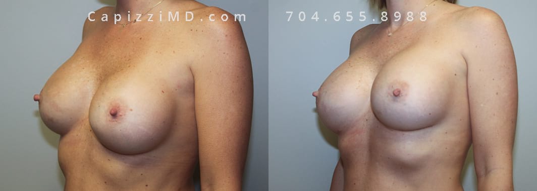 Desired more volume and cleavage. Sientra Textured Round High Projection 505cc. Post-op 3 months. Oblique view.