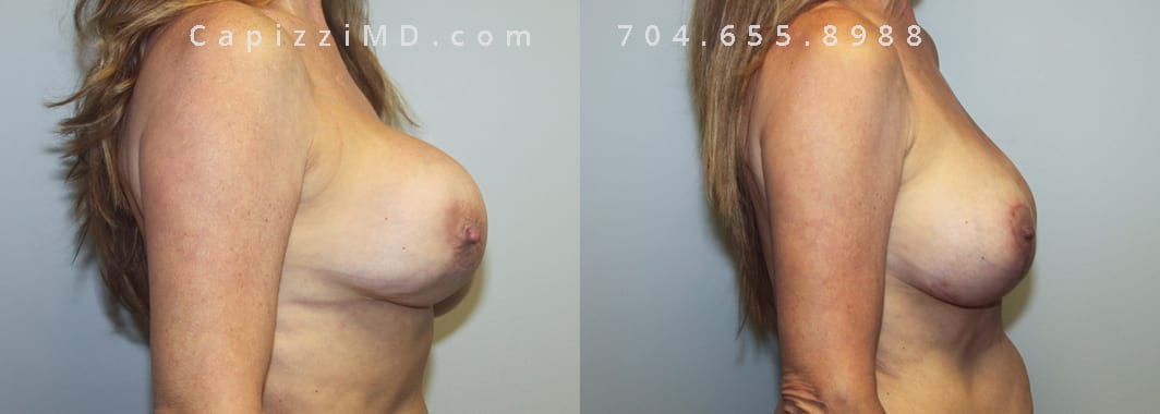 Pain/hardness from a capsular contracture. Two different brands of saline implants (370 and 390 cc). Replaced with Sientra Smooth Round HP 385cc. Partial capsulectomy and full lift added to correct asymmetry and sagging. 3 months post op. Side View.