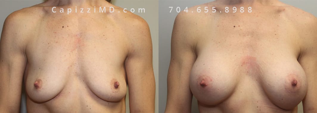 Breast Augmentation Allergan HP 365cc, Standard Tummy Tuck. Breasts: 1 month post-op, Abdomen: 1 year post-op, Front View.