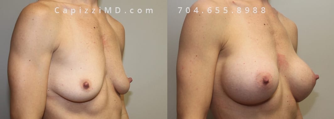 Breast Augmentation Allergan HP 365cc, Standard Tummy Tuck. Breasts: 1 month post-op, Abdomen: 1 year post-op, Oblique View.