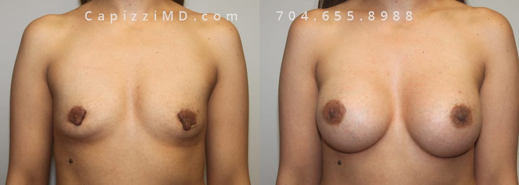Breast Augmentation Sientra Smooth Round 350cc, Nipple Reduction, Standard Tummy Tuck Front View.