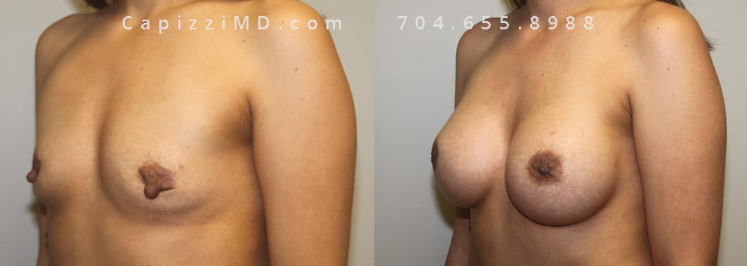 Breast Augmentation Sientra Smooth Round 350cc, Nipple Reduction, Standard Tummy Tuck. Oblique View.