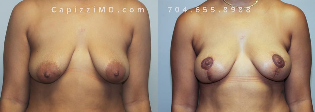 Modified Breast Lift, 1-month post-op. Front View.