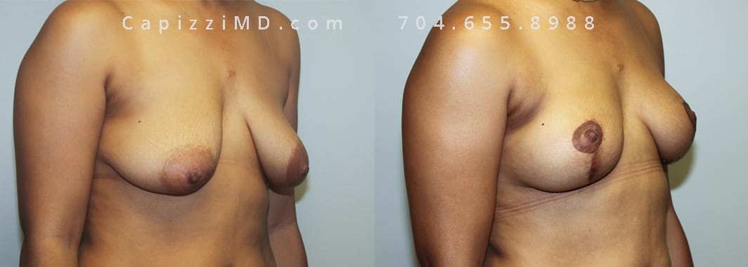 Modified Breast Lift, 1-month post-op. Oblique View.