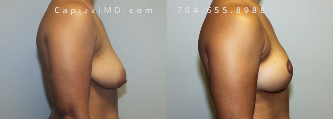Modified Breast Lift, 1-month post-op. Side View.
