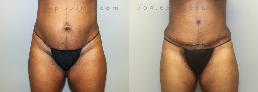 Standard Tummy Tuck, diastasis recti repair. Liposuction to posterior hips (love handles) 600cc fat removed.