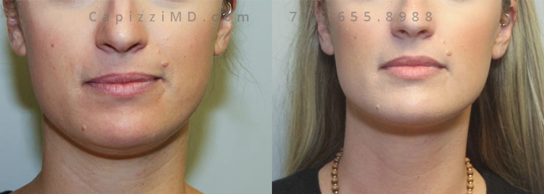 1 treatment Kybella. 6 weeks post-treatment. Front view.