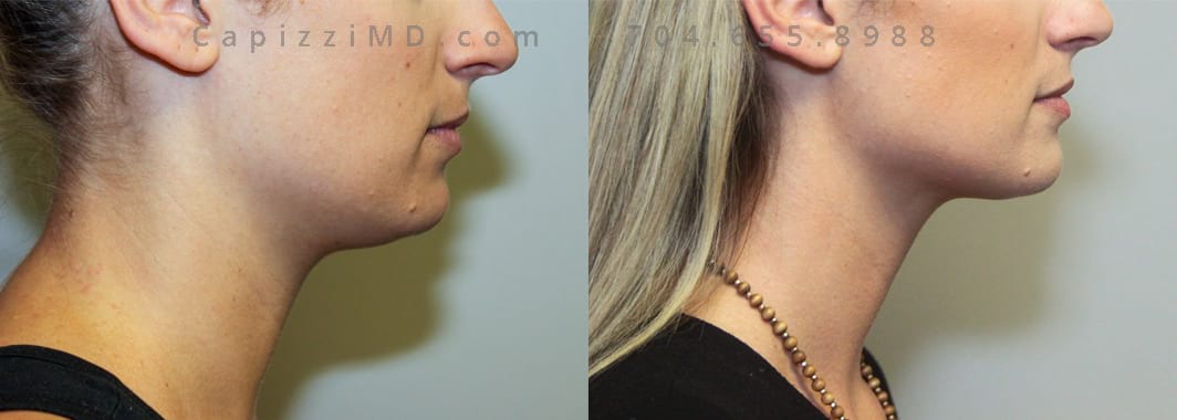 1 treatment Kybella. 6 weeks post-treatment. Right view.