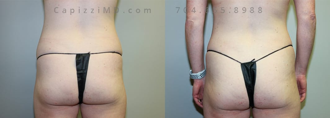 Liposuction to abdomen and posterior hips. 12 months post-procedure. 1600 cc of fat removed. Back view.