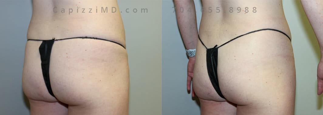 Liposuction to abdomen and posterior hips. 12 months post-procedure. 1600 cc of fat removed. Back oblique view.