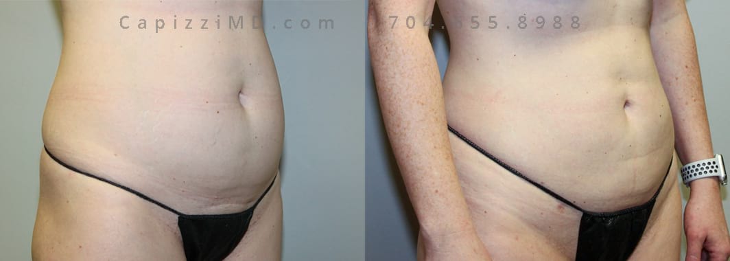 Liposuction to abdomen and posterior hips. 12 months post-procedure. 1600 cc of fat removed. Oblique view.