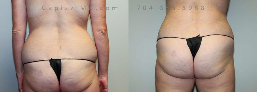 Liposuction to posterior hips (love handles), abdomen, and thighs. 2 months Post-op. Back view.