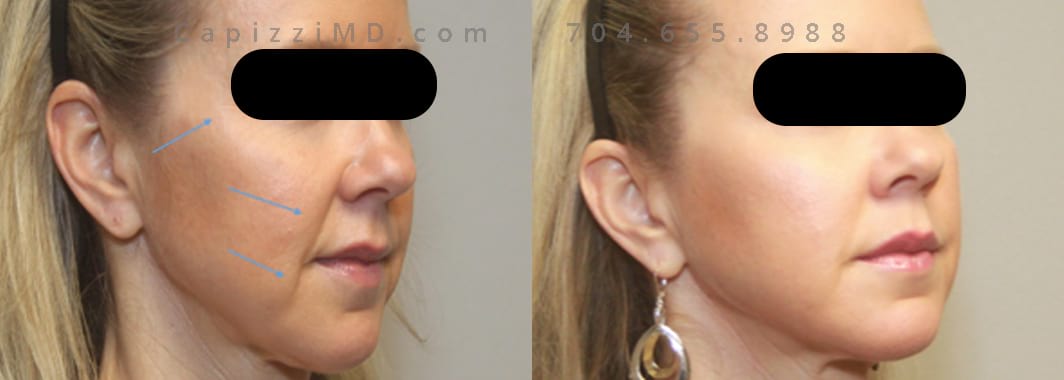 Dull skin and complexion. Crow’s feet improved significantly at 4- and 10-weeks post-treatment. Smile Lines) improved significantly. Skin above the upper lip looks smoother. Chin’s “pebble” appearance smoothed significantly.