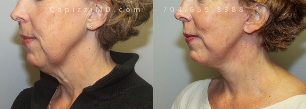 50 year old with Mini Face Lift & Micro Laser Peel. Left Oblique view.