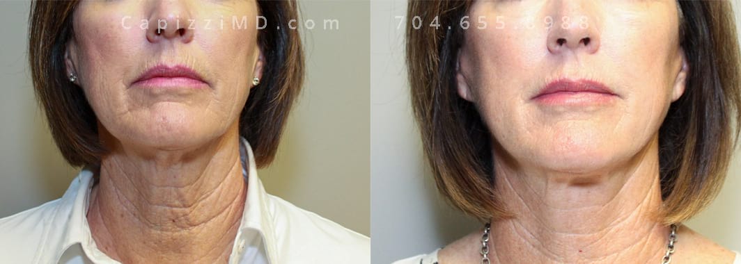 Lower facelift with Microlaser peel to face and neck. 7 months post-op. Front view.