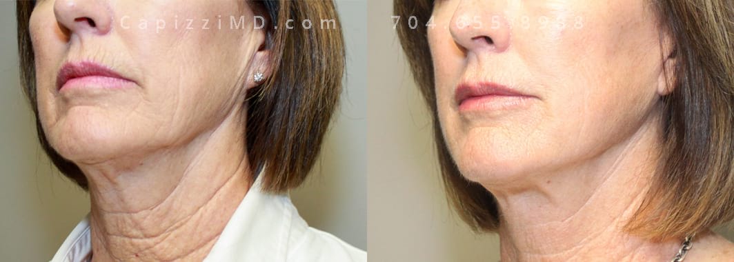 Lower facelift with Microlaser peel to face and neck. 7 months post-op. Left oblique view.