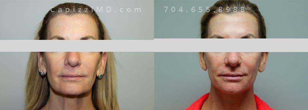 Mini facelift and Microlaser Peel to face and neck. 2 weeks post-op. Front View.
